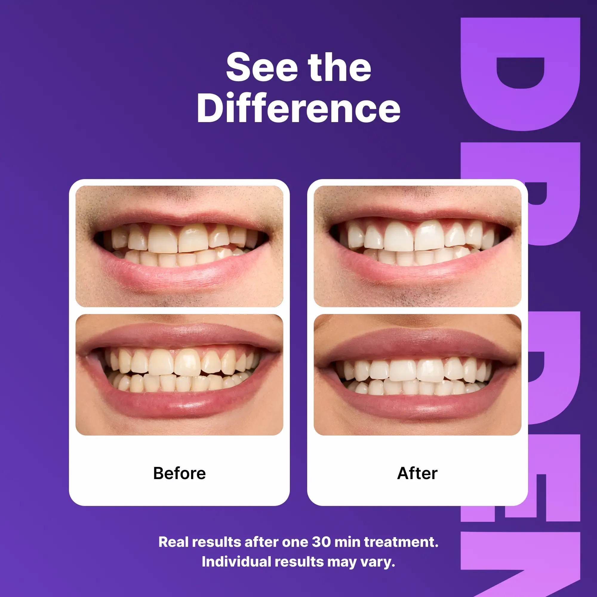 Purple Teeth Whitening Strips